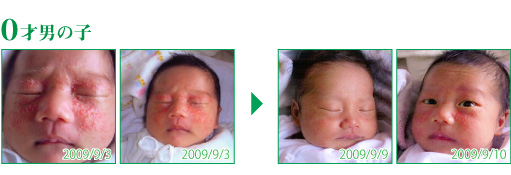 乳児湿疹は下関天恵堂にご相談ください