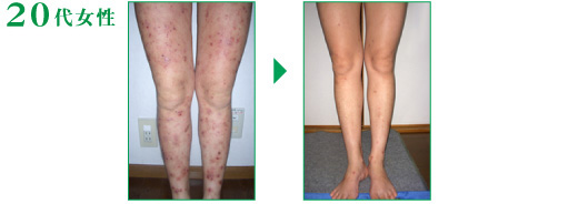 アトピー、湿疹