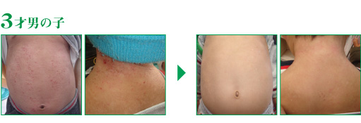 アトピーは腸から改善